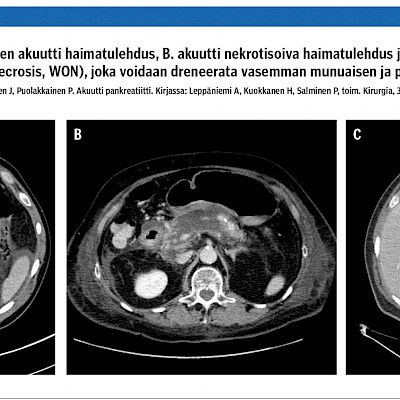 Akuutin haimatulehduksen diagnostiikka ja hoito