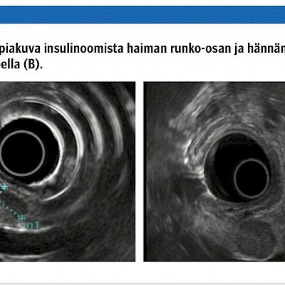 Endoskopia haimasairauksien diagnostiikassa