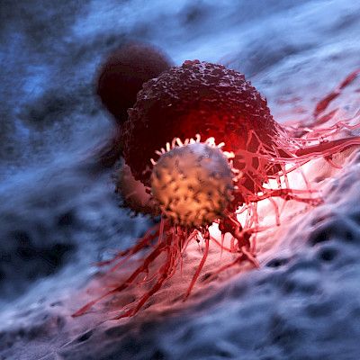 Ensimmäiset syöpäpotilaat hoidettu uudella immunologisella täsmähoidolla