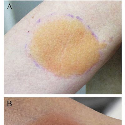 Yellow urticaria in a 68-year old man