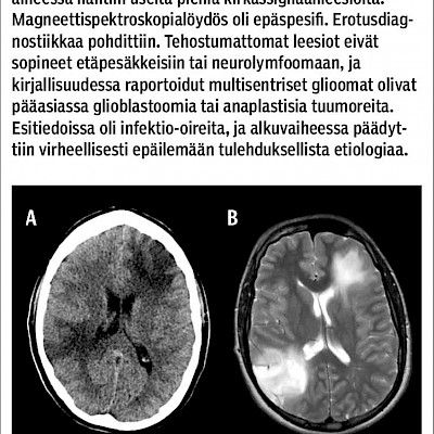 Rare brain disorder in a colleague