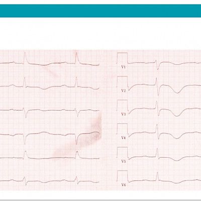 Kysymys: Mielialahäiriö, jähmeys ja EKG-muutos