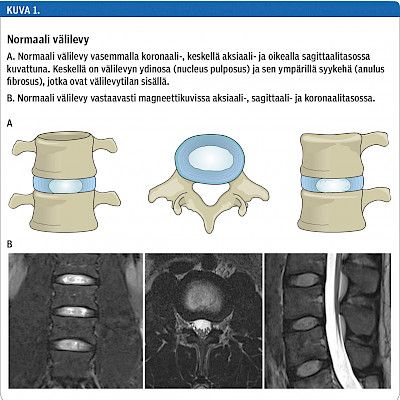 Unified terminology needed for degenerative changes of the lumbar disc
