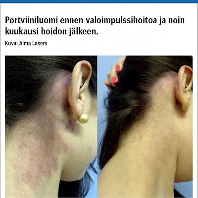 Laserhoidot ihotaudeissa ja ihon esteettisessä korjailussa