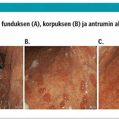 Kliininen kysymys: Vatsakipuisen maksapotilaan gastroskopialöydös