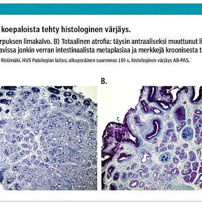 Kliininen vastaus: Vatsakipuisen maksapotilaan gastroskopialöydös