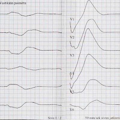 Kliininen kysymys: Hurja EKG