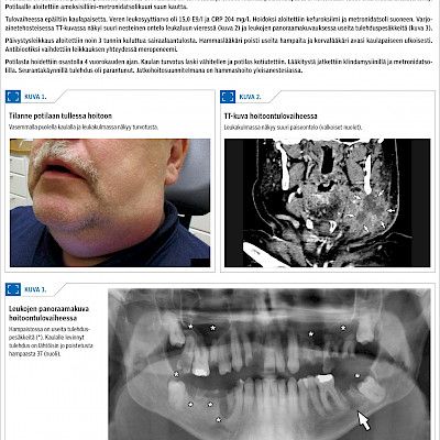 Surgically treated deep neck infections in North Karelia from 2010 to 2016