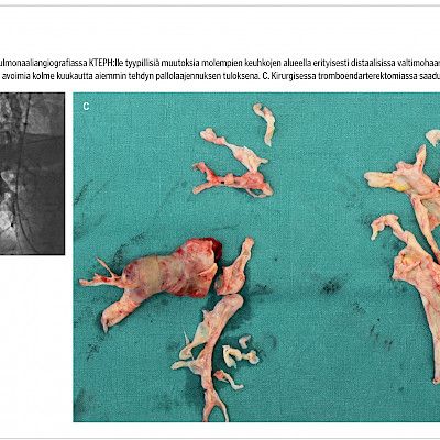 Percutaneous balloon pulmonary angioplasty – a new treatment for chronic thromboembolic pulmonary hypertension