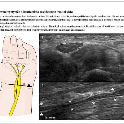 Ääreishermojen kaikukuvaus ENMG:n yhteydessä  Erityistarkastelussa rannekanavaoireyhtymä