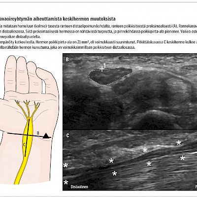 Ääreishermojen kaikukuvaus ENMG:n yhteydessä  Erityistarkastelussa rannekanavaoireyhtymä