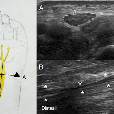 Kaikukuvaus auttaa hermovaurioiden diagnostiikassa