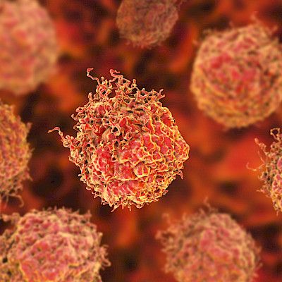 Imusolmukkeisiin levinnyt eturauhassyöpä ei ole parantumaton