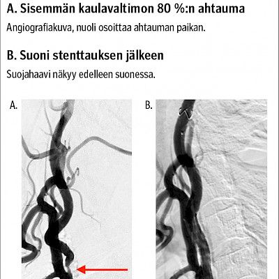 Milloin kaulavaltimoahtauman hoito on aiheellista?