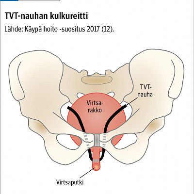 Naisten virtsankarkailun nauhaleikkaukset