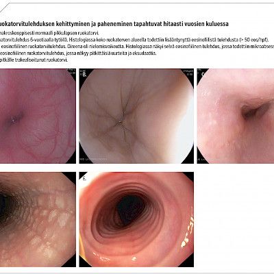 Miten tunnistan eosinofiilisen ruokatorvitulehduksen?