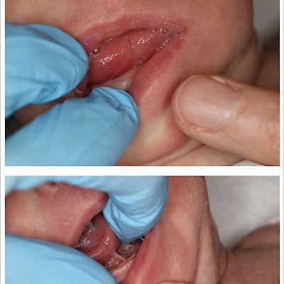 Tight lingual frenulum and upper lip frenulum – what do they cause and do they require treatment?