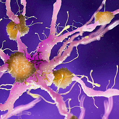 Alzheimerin taudin riskigeeni heikentää aivojen tulehdussolujen toimintaa