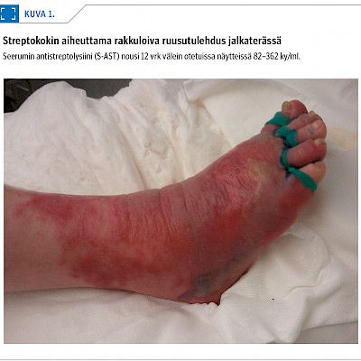 Diagnosis and treatment of common cellulitis