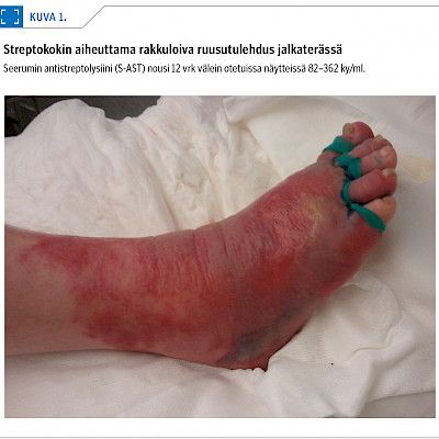 Ruusutulehdus – diagnosoi oikein, lopeta hoito ajoissa