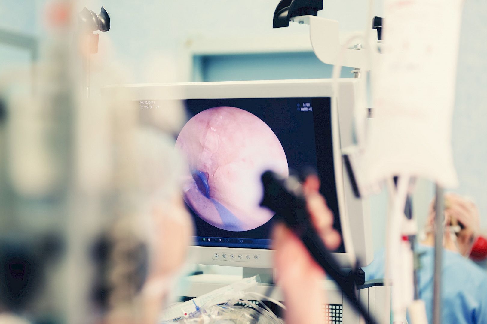 Endoskooppinen ultraääni voi korvata leikkauksen 