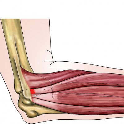 Pitkittyneelle kyynärvaivalle on tärkeää löytää syy