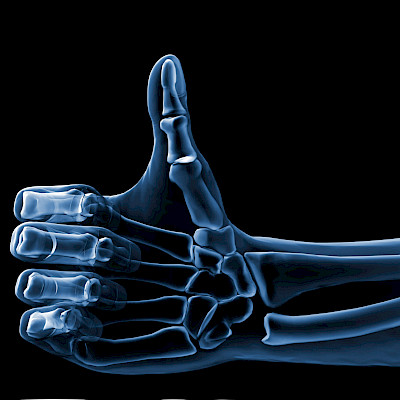 Digital X-ray radiogrammetry (DXR) in patients with fractures