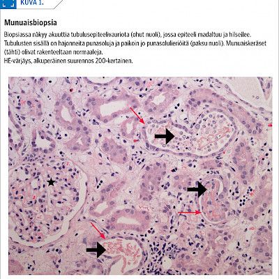 Severe haemolysis and kidney failure after red blood cell transfusions