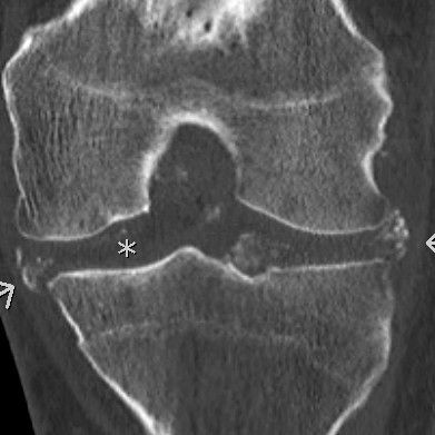 Calcium pyrophosphate deposition associated with many clinical pictures