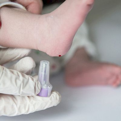 Metioniinista merkkiaine tyypin 1 diabeteksen ennustamiseen?