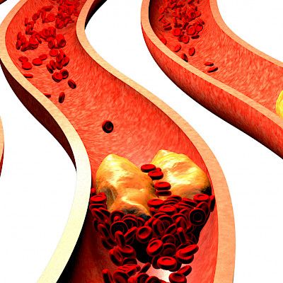 Hyötyykö diabetesta sairastava sepelvaltimo­tautipotilas anti­tromboottisen hoidon tehostamisesta?