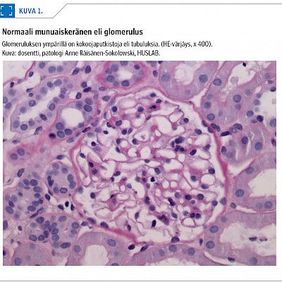 Glomerulonephritis