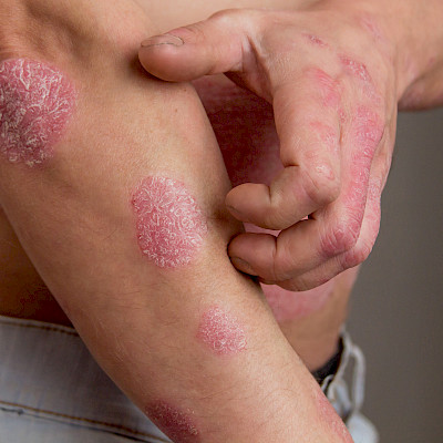 Psoriasis sai maailmanlaajuisen tietopankin