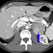 Phaeochromocytoma – a rare and unexpectedly behaving adrenal tumour