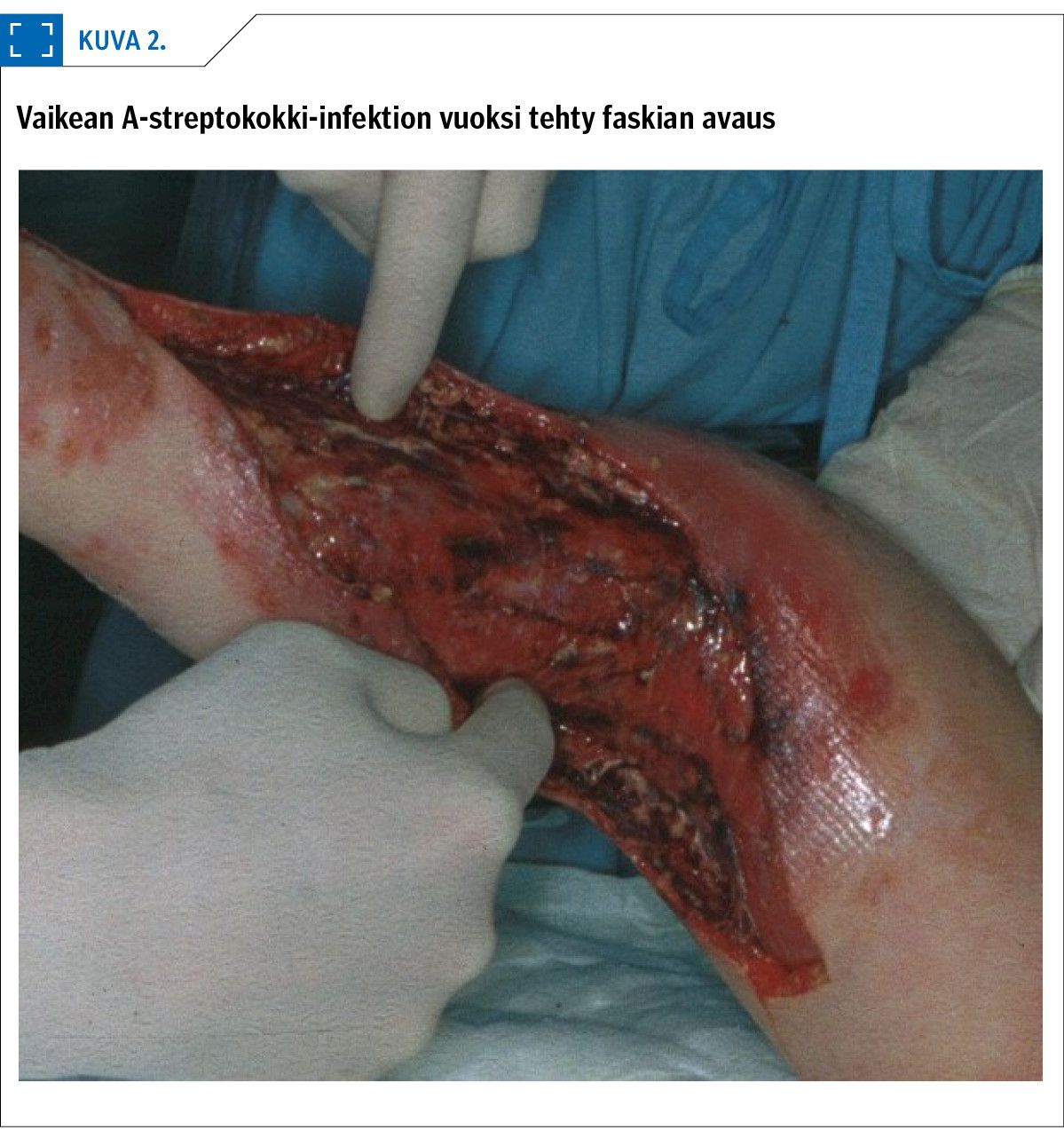 Vaikean A-streptokokki-infektion vuoksi tehty faskian avaus