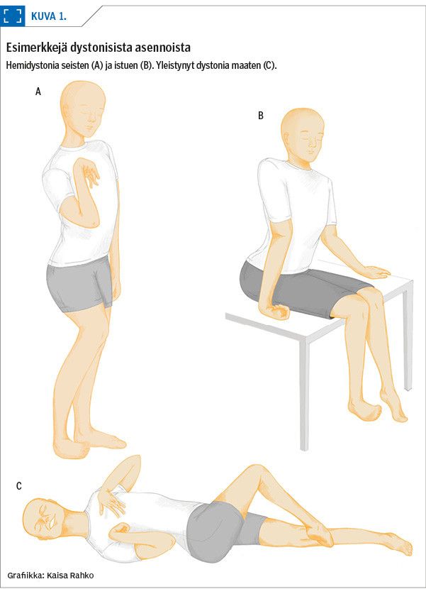 Esimerkkejä dystonisista asennoista<p/>