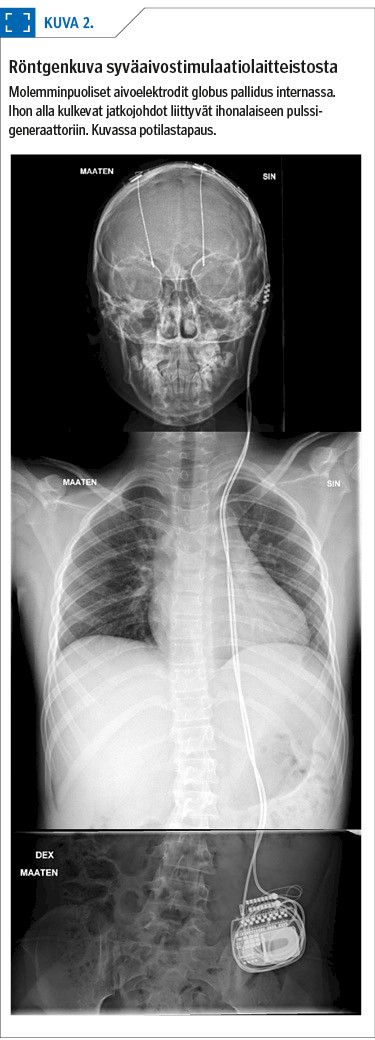 Röntgenkuva syväaivostimulaatiolaitteistosta