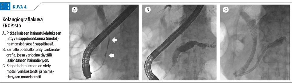 Kolangiografiakuva ERCP:stä