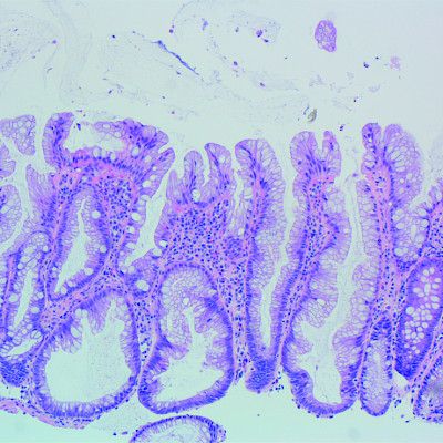 Paksusuolen adenoomien ja sahalaitamuutosten histologia ja kontrollitähystysten tarve