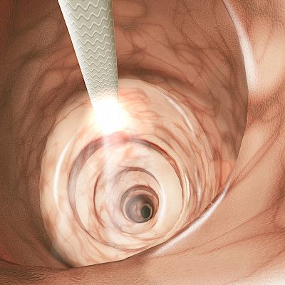 When to send a patient for endoscopy?<p/>