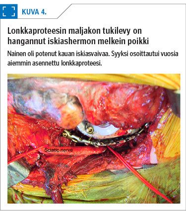 Lonkkaproteesin maljakon tukilevy on  hangannut iskiashermon melkein poikki