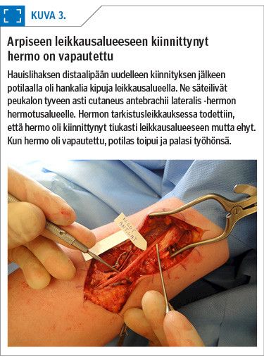 Arpiseen leikkausalueeseen kiinnittynyt  hermo on vapautettu