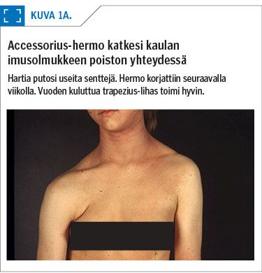 Accessorius-hermo katkesi kaulan imusolmukkeen poiston yhteydessä