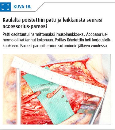 Kaulalta poistettiin patti ja leikkausta seurasi accessorius-pareesi