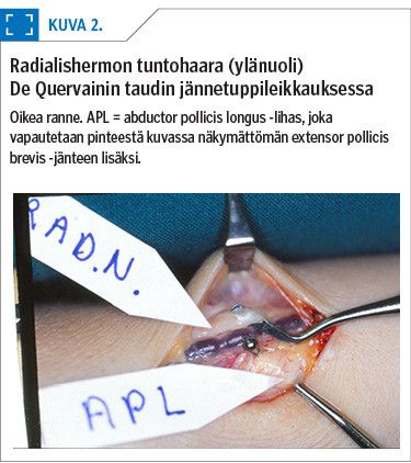 Radialishermon tuntohaara (ylänuoli) De Quervainin taudin jännetuppileikkauksessa
