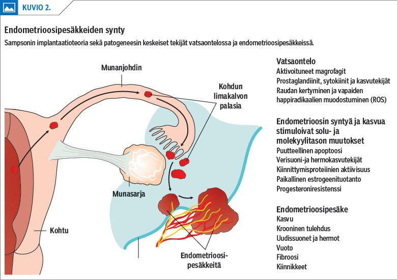 Endometrioosipesäkkeiden synty