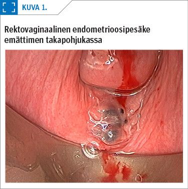 Rektovaginaalinen endometrioosipesäke emättimen takapohjukassa