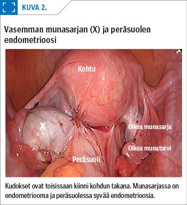 Vasemman munasarjan (X) ja peräsuolen endometrioosi