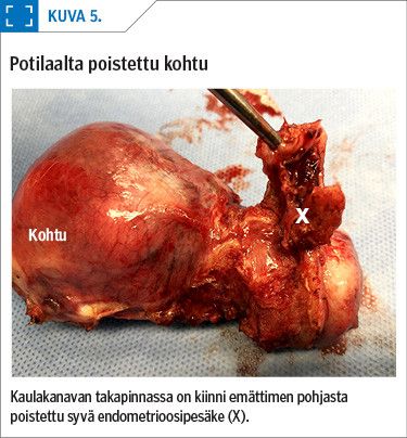 Potilaalta poistettu kohtu