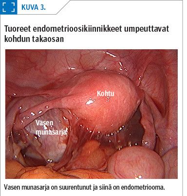 Tuoreet endometrioosikiinnikkeet umpeuttavat kohdun takaosan